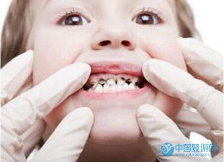 寶寶乳牙齲齒的危害