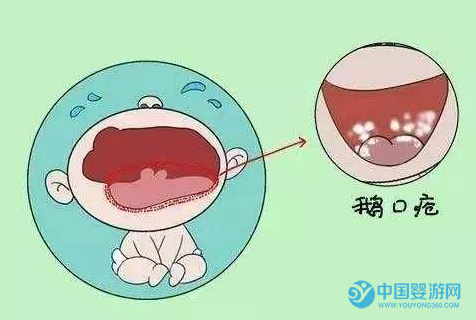 新生兒鵝口瘡的預防和治療