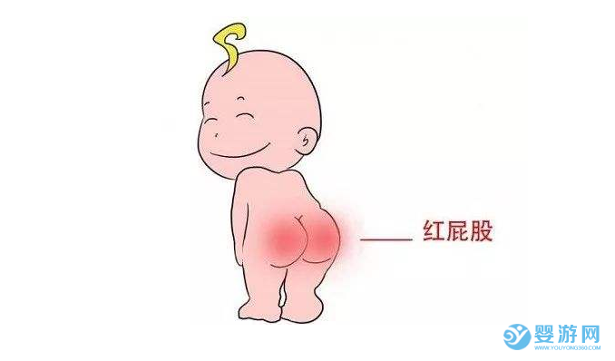 夏季緩解寶寶紅屁屁的五個好方法，絕對實用！夏季寶寶紅屁屁怎么辦 寶寶紅屁屁緩解方法 如何預防寶寶紅屁屁1