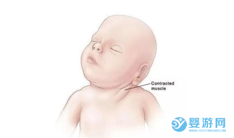 【干貨】怎么判斷寶寶是否歪頭？寶寶歪頭怎么糾正？ 寶寶歪頭糾正方法 判斷寶寶歪頭的方法2