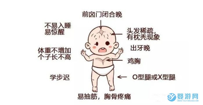 寶寶佝僂病是怎么回事？有什么表現？又該如何預防？ 佝僂病是怎么回事 造成佝僂病的原因 佝僂病有什么表現 如何預防佝僂病1